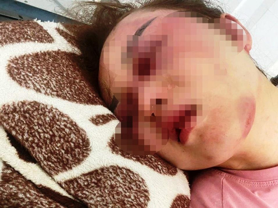 Chị V. bị đánh phải nhập viện. Chị V. bị đánh phải nhập viện.