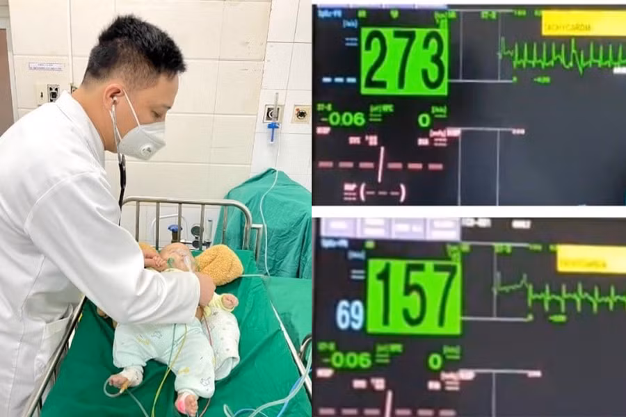 Nhịp tim của trẻ trước và sau khi làm nghiệm pháp.
