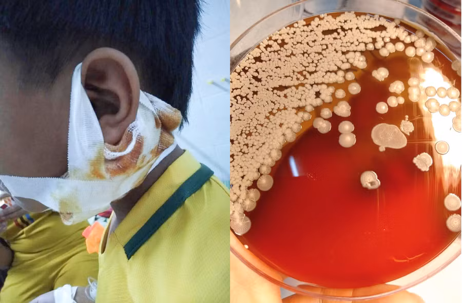 Vi khuẩn ăn thịt người thường có trong bùn, đất, nước bị ô nhiễm.