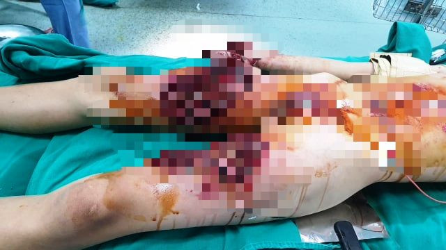 Phần đùi của em Phạm Xuân L. bị thương nặng khi quả pháo phát nổ. Ảnh: Bệnh viện Nhi Thanh Hóa cung cấp. Phần đùi của em Phạm Xuân L. bị thương nặng khi quả pháo phát nổ. Ảnh: Bệnh viện Nhi Thanh Hóa cung cấp.