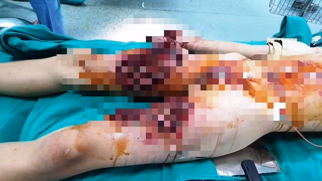 Phần đùi của em Phạm Xuân L. bị thương nặng khi quả pháo phát nổ. Ảnh: Bệnh viện Nhi Thanh Hóa cung cấp.