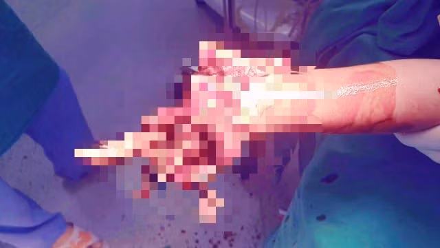 Hình ảnh bàn tay phải của nam sinh Phạm Xuân L. bị dập nát. Ảnh: Bệnh viện Nhi Thanh Hóa cung cấp. 