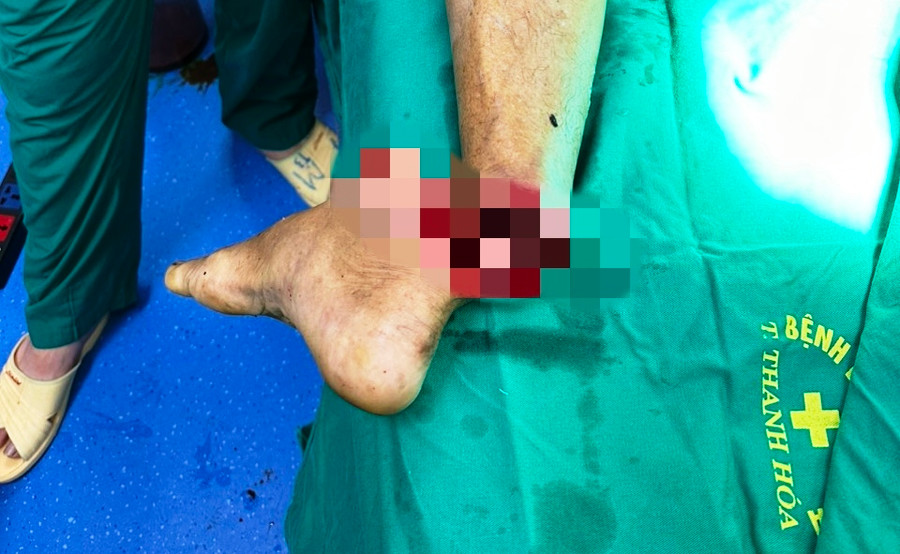 Bàn chân của bệnh nhân bị đứt rời. Ảnh: BVCC. Bàn chân của bệnh nhân bị đứt rời. Ảnh: BVCC.