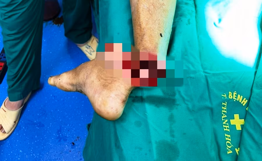 Bàn chân của bệnh nhân bị đứt rời. Ảnh: BVCC.