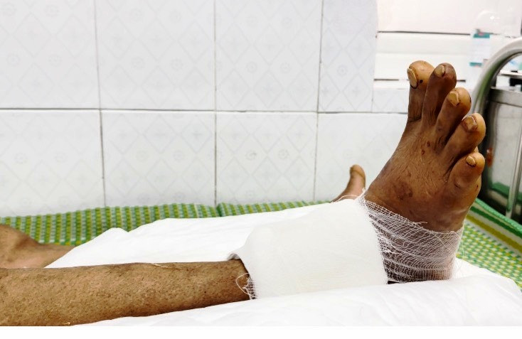 Bàn chân của bệnh nhân đã được bác sĩ nối lại thành công. Ảnh: BVCC. Bàn chân của bệnh nhân đã được bác sĩ nối lại thành công. Ảnh: BVCC.