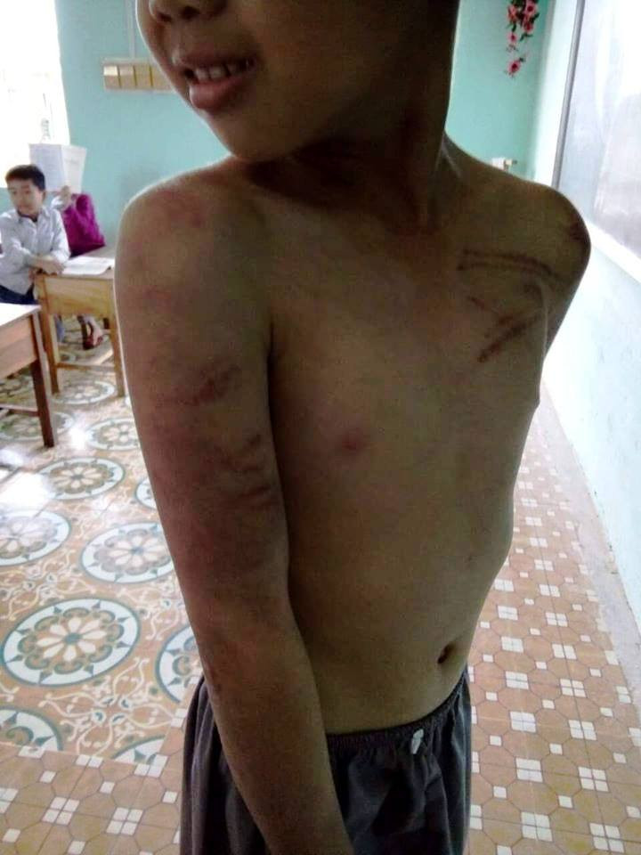 Cháu N.C.D. bị sư thầy Thích Đàm Trang dùng roi đánh từ năm học 2016-2017.