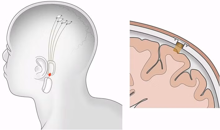 Theo vị tỷ phú Mỹ, sự chấp thuận của FDA là kết quả của công việc đáng kinh ngạc từ nhóm Neuralink với sự hợp tác chặt chẽ với FDA. "Điều này thể hiện bước đầu tiên quan trọng mà một ngày nào đó sẽ cho phép công nghệ của chúng tôi giúp đỡ nhiều người." Tỷ phú Elon Musk công bố sắp cấy chip vào não người