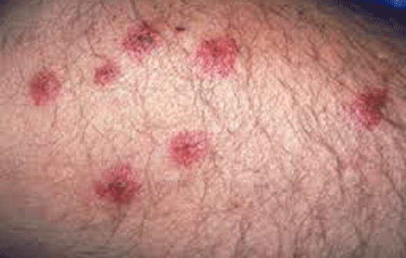 Nếu phát hiện đám trứng này trên quần áo, hãy loại bỏ ngay trước khi gánh chịu hậu quả khôn lường ảnh 4