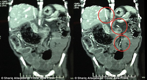hội chứng, phẫu thuật, x-quang, Ấn Độ, tóc, ăn, tiến sĩ, bệnh viện, khoa nhi, chẩn đoán