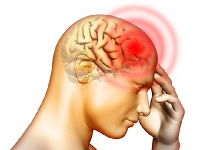 Nhận diện dấu hiệu ung thư não theo từng giai đoạn