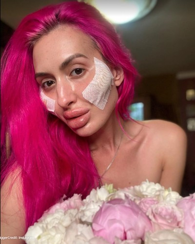 Người ta bơm vòng nọ vòng kia, riêng cô này chỉ bơm má để có “hai gò má to nhất thế giới” - ảnh 4