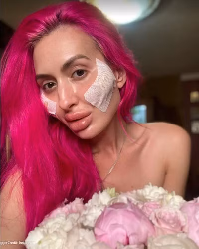 Người ta bơm vòng nọ vòng kia, riêng cô này chỉ bơm má để có “hai gò má to nhất thế giới” - ảnh 4