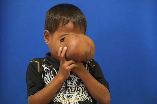 Cậu bé Jhonny Lameon trước khi được phẫu thuật