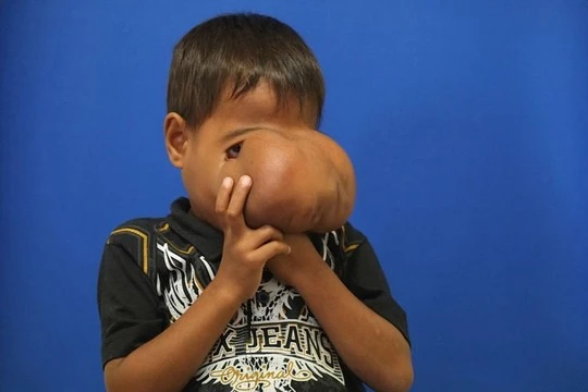 Cậu bé Jhonny Lameon trước khi được phẫu thuật