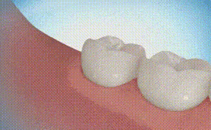 
Mô phỏng quá trình nhổ răng khôn. Ảnh:Imgur.
