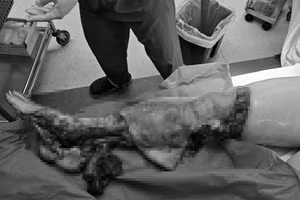 Da chân bệnh nhân N.T.N bị lóc sau tai nạn giao thông. Ảnh: BVCC