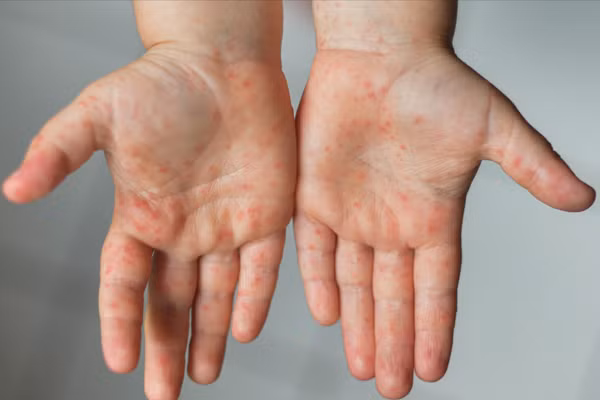 Hình ảnh điển hình của bệnh tay chân miệng với các nốt phát ban ở tay, chân và vùng miệng, thường gặp ở trẻ nhỏ. Ảnh minh hoạ.