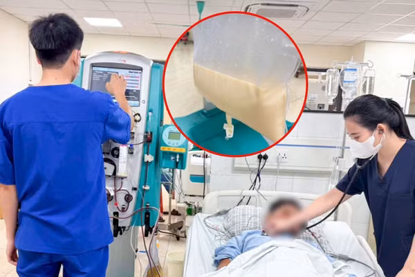 Bệnh nhân bị viêm tụy cấp do tăng Triglycerid (tăng mỡ máu). Ảnh: INT