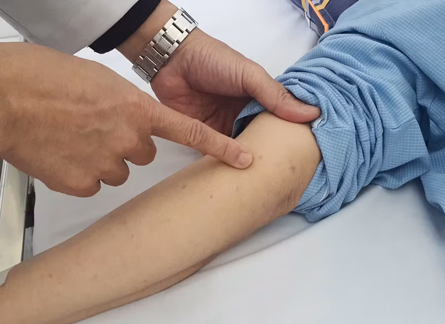 Ban xuất huyết hoại tử trên da bệnh nhân. Ảnh: Bệnh viện Bạch Mai cung cấp