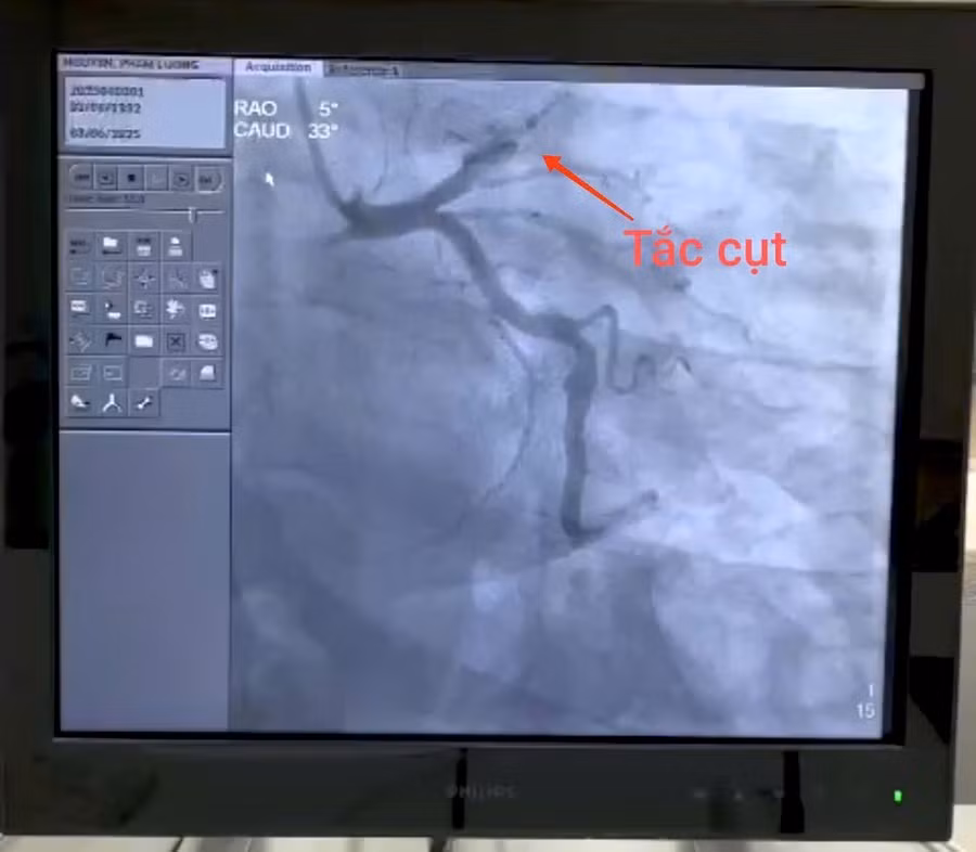 Hình ảnh cho thấy, bệnh nhân bị nhồi máu cơ tim, gây tắc nghẽn hoàn toàn từ đoạn 1, động mạch liên thất trước. Ảnh: BVCC 