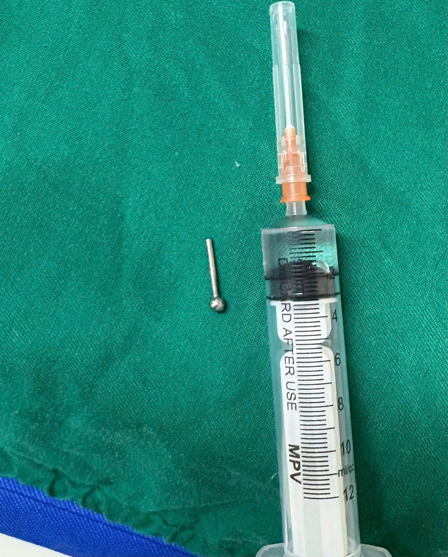 Chiếc khuyên lưỡi được gắp ra khỏi dạ dày bệnh nhân. Ảnh: BVCC
