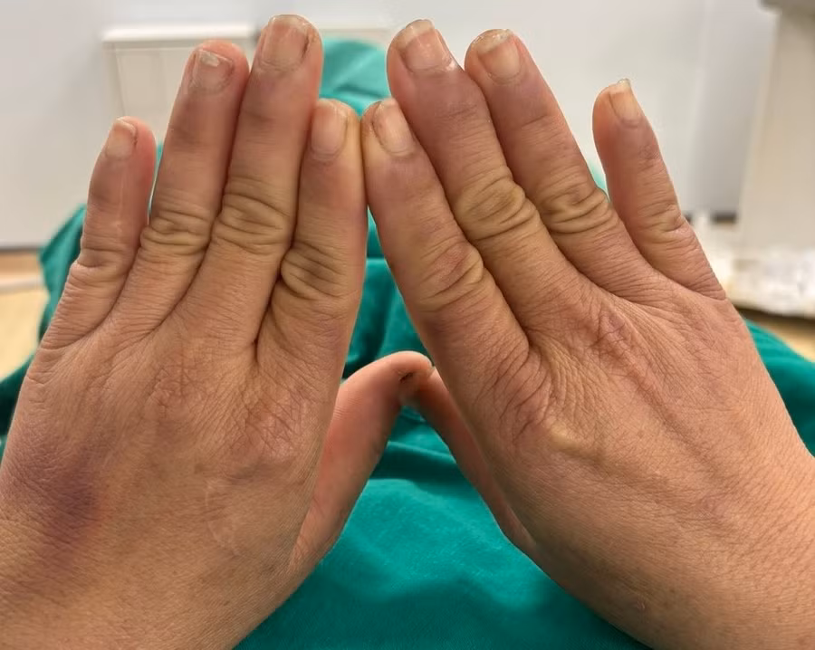 Bàn tay của người bệnh bị tím tái, ngón tay trắng nhợt mỗi khi chạm vào nước. Ảnh: BVCC