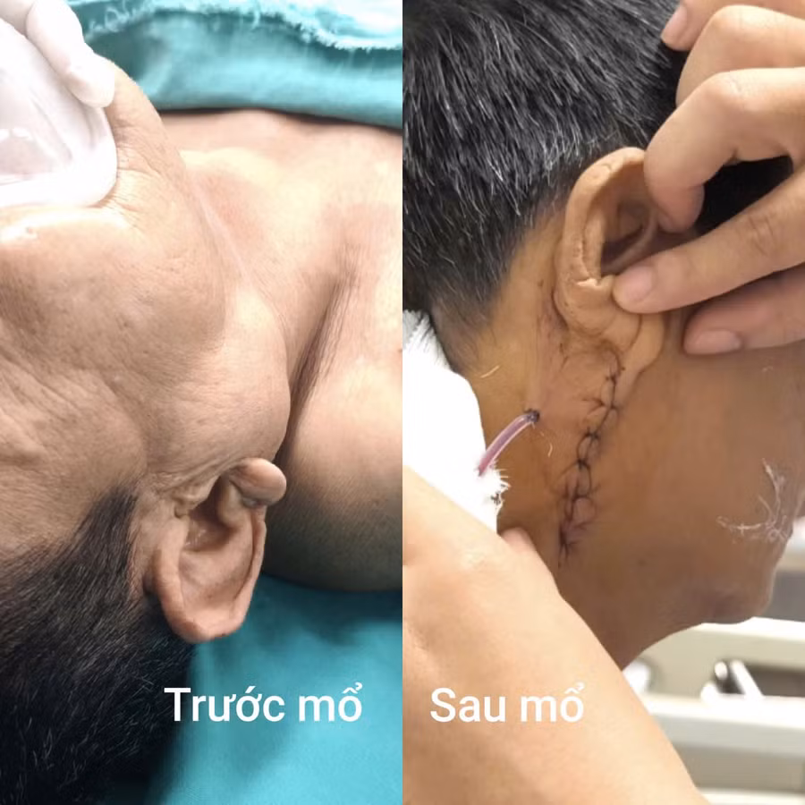 Hình ảnh bệnh nhân trước và sau phẫu thuật. Ảnh: BVCC