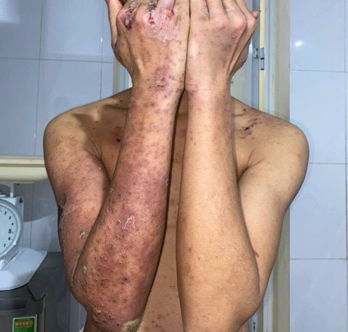 Do tự ý sử dụng một số phương pháp dân gian, nên bệnh nhân gặp những tổn thương nghiêm trọng trên da. Ảnh: BVCC