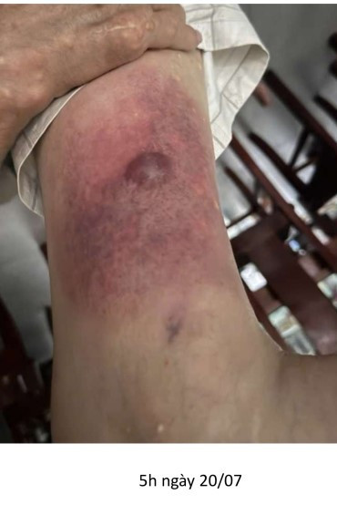 Bệnh nhân nhập viện trong tình trạng vùng đùi phải sưng to, căng tức, xuất hiện nhiều nốt phỏng nước chứa dịch màu nâu đen. Ảnh: BVCC 