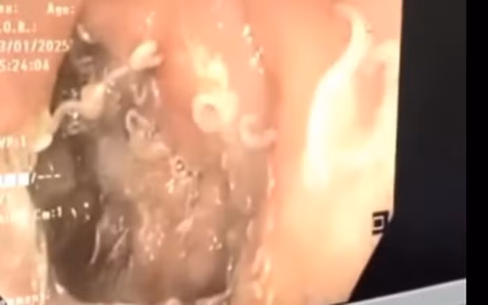 Kết quả nội soi cho thấy, thành tá tràng của bệnh nhân có rất nhiều giun móc rất nhỏ bám chặt. Ảnh: BVCC