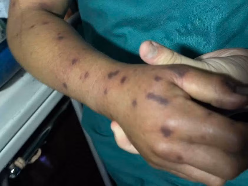 Bệnh nhân bị sốc phản vệ độ 3 do ong đốt.