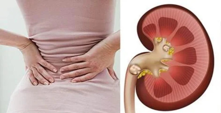 Sỏi thận gây ảnh hưởng nhiều đến chất lượng cuộc sống. Ảnh minh họa: INT