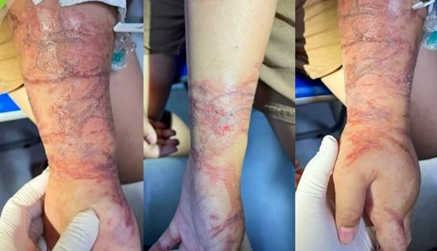 Trẻ tổn thương da do ôm sứa lúc tắm biển. Ảnh: BVCC