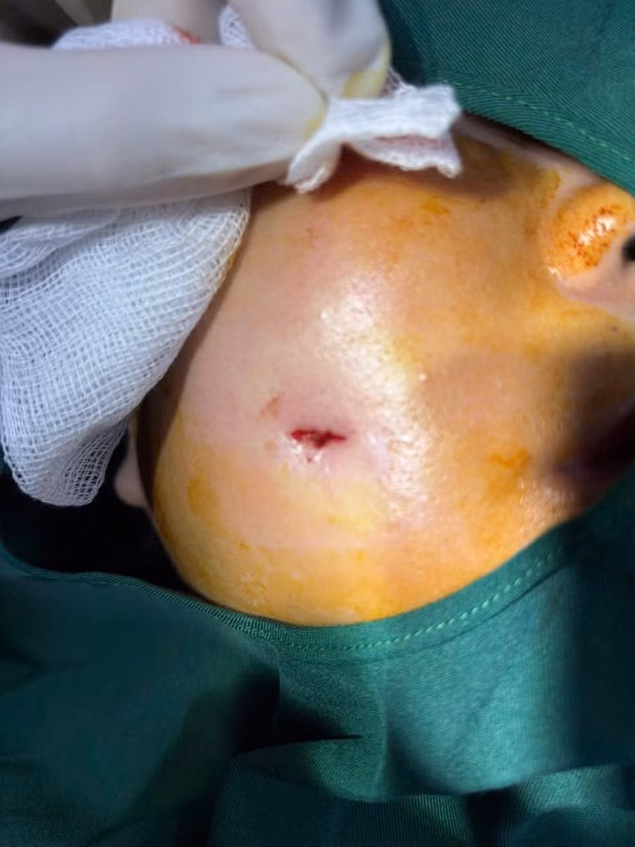 Bệnh nhân có lỗ rò chảy mủ ở niêm mạc má tại vị trí thắt đồng tiền sau thực hiện tạo hình. Ảnh: BVCC