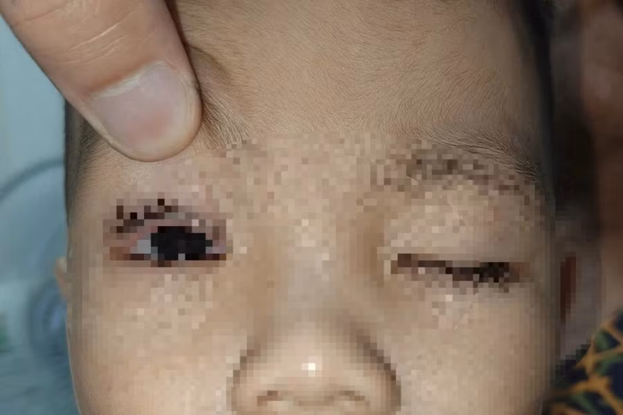 Các bác sĩ đã cho trẻ sử dụng kháng sinh, chống viêm, dưỡng giác mạc. Ảnh: BVCC