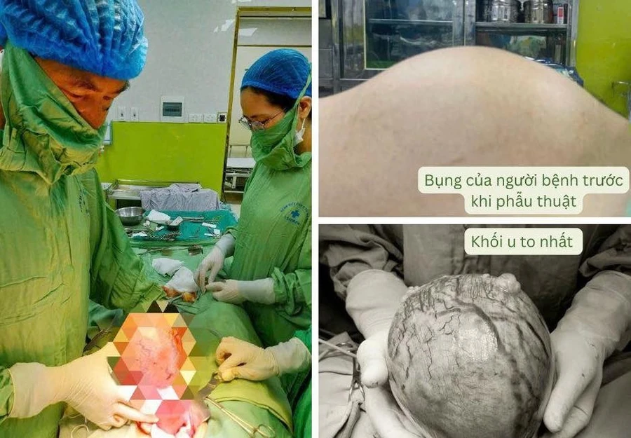Người phụ nữ 42 tuổi ở Hòa Bình có khối u 'khủng' như mang thai 3 tháng từ sai lầm nhiều chị em Việt mắc phải - Ảnh 2. Người phụ nữ 42 tuổi ở Hòa Bình có khối u 'khủng' như mang thai 3 tháng từ sai lầm nhiều chị em Việt mắc phải - Ảnh 2.