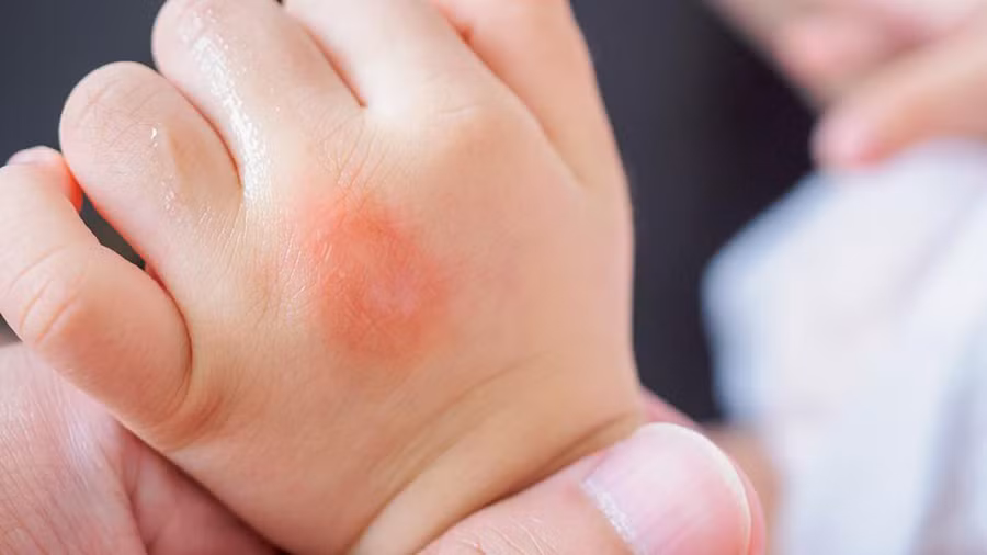 Muỗi thích những người có thể chất có tính axit. (Ảnh: ITN)