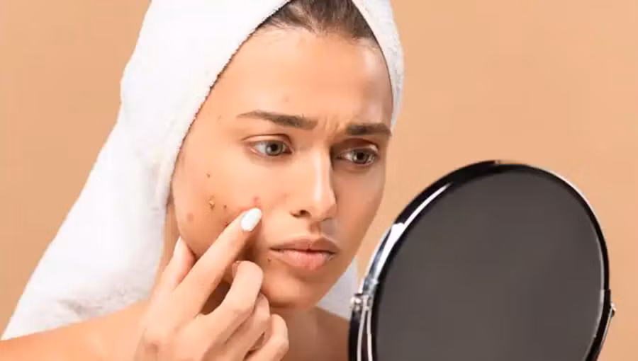 Nội tiết tố đóng một vai trò quan trọng gây ra mụn bọc. Chúng điều chỉnh việc sản xuất dầu trên da, góp phần làm tắc nghẽn lỗ chân lông và gây viêm. (Ảnh: ITN)