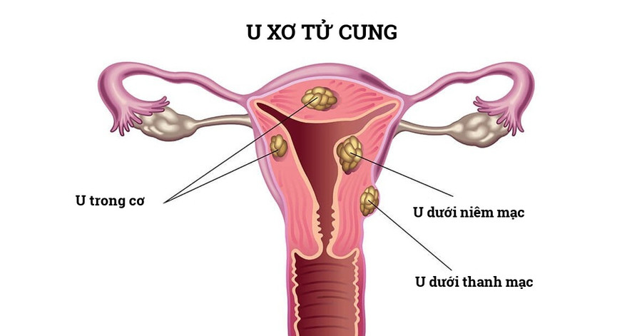 3 vị trí thường gặp của u xơ tử cung image001.png