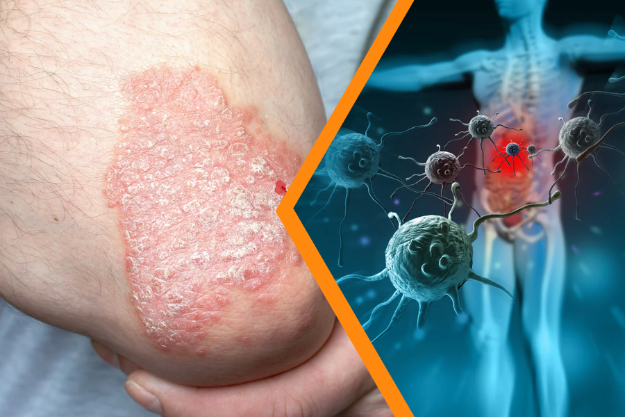 Hiểu rõ vảy nến da đầu để điều trị đúng, ngừa tái phát hiệu quả ảnh 2