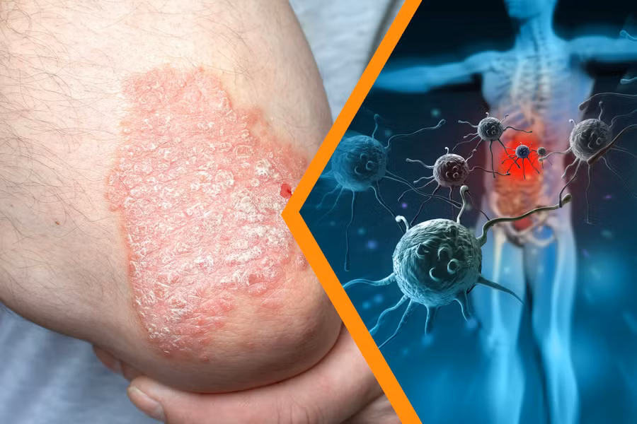 Hiểu rõ vảy nến da đầu để điều trị đúng, ngừa tái phát hiệu quả ảnh 2