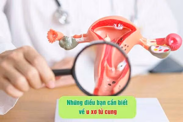 Những điều bạn cần biết về u xơ tử cung