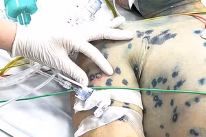 Người trưởng thành khi mắc thuỷ đậu có thể đối mặt với nhiều biến chứng nguy kịch. (Ảnh: Bộ Y tế)