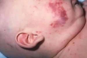 Triệu chứng của bệnh viêm não mô cầu. 