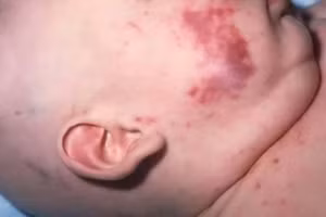 Triệu chứng của bệnh viêm não mô cầu. 