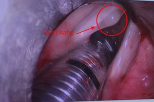 Hình ảnh khối u nang. 