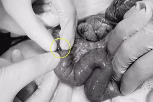 Các bác sĩ thực hiện lấy viên bi ra khỏi ruột bệnh nhi.