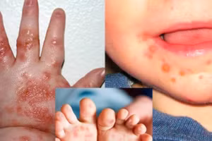 Biểu hiện điển hình của bệnh tay chân miệng ở trẻ. (Ảnh; INT)