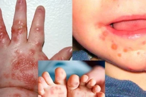 Biểu hiện điển hình của bệnh tay chân miệng ở trẻ. (Ảnh; INT)