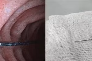 Hình ảnh dị vật trước và sau khi được các bác sĩ lấy ra. 